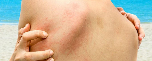 CALDO E UMIDO: L'HABITAT IDEALE PER LE INFEZIONI DELLA PELLE