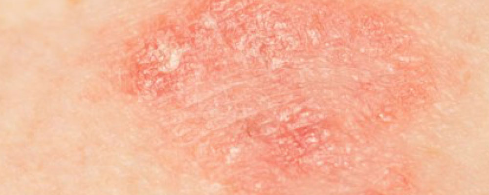 RIMEDI PER LA PELLE ATOPICA