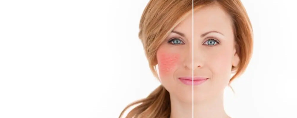 PELLE SENSIBILE O INTOLLERANTE? COME RICONOSCERLA E COSA FARE