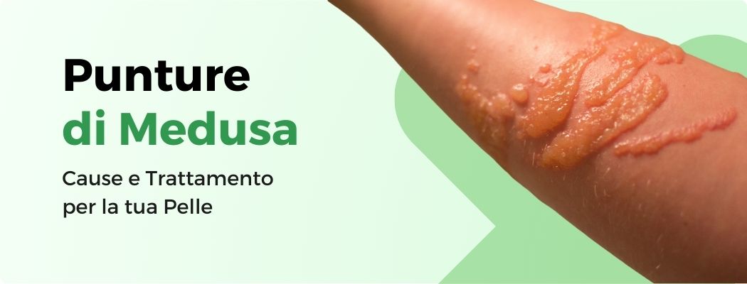 PUNTURA DI MEDUSA: PREVENZIONE E TRATTAMENTO PER LA TUA PELLE